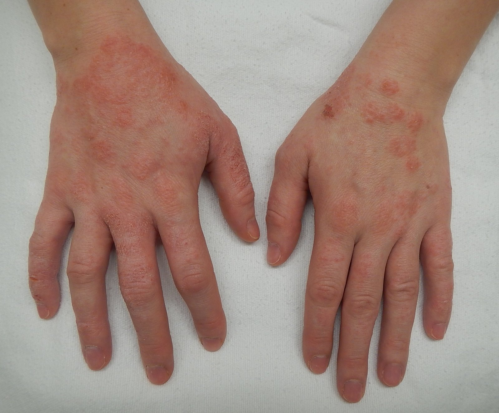 Dermatitis - Joven Skin Hair & Laser Clinic