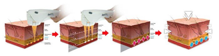 HIFu - Joven Skin Hair & Laser Clinic