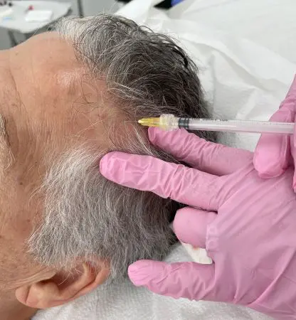 Hair dermatosurgery - Joven Skin Hair & Laser Clinic