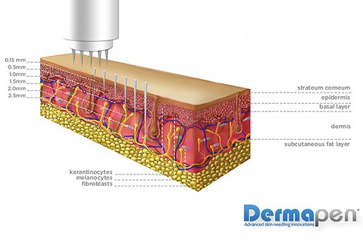 dermapen with exosomes