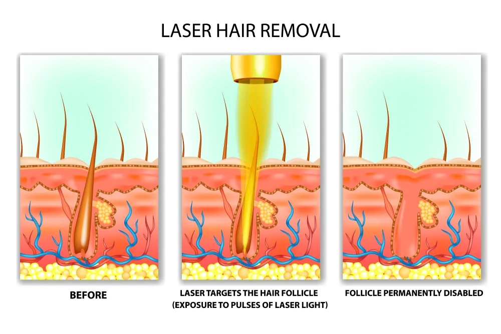 Laser hair reduction at Joven