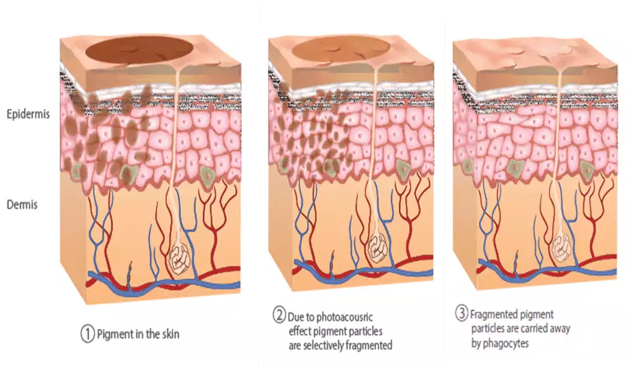 Q-Switched Laser Working | Joven Skin Hair Clinic