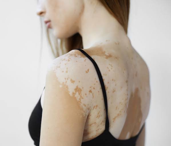 Vitiligo - Joven Skin Hair & Laser Clinic
