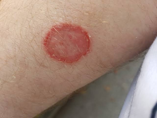 fungal skin infection 1 - Joven Skin Hair & Laser Clinic