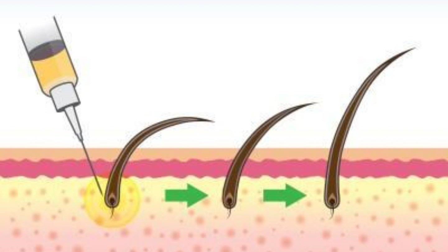 mesotherapy - Joven Skin Hair & Laser Clinic