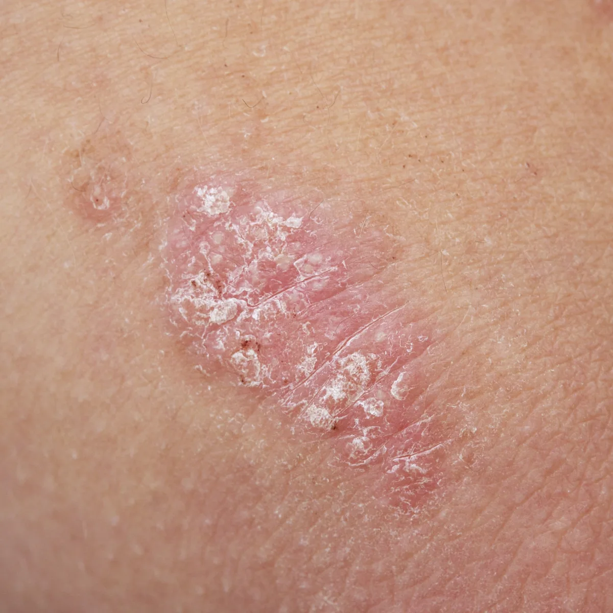 psoriasis - Joven Skin Hair & Laser Clinic