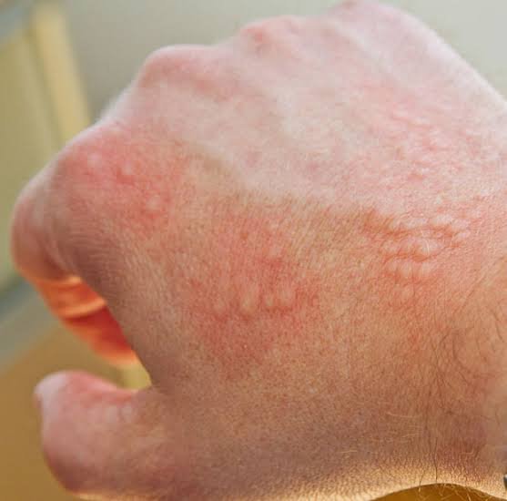 skin allergies - Joven Skin Hair & Laser Clinic